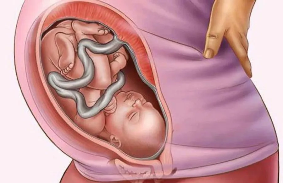Truyền máu cuống rốn tiềm ẩn nhiều nguy cơ biến chứng cho mẹ và thai nhi