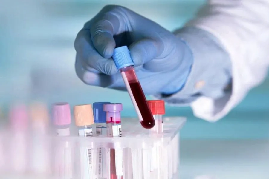 Xét nghiệm máu tiền hôn nhân giúp giảm thiểu nguy cơ sinh ra trẻ mang bệnh tan máu bẩm sinh Thalassemia