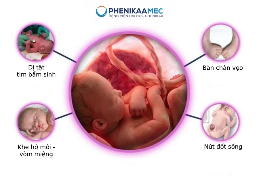 Một số dị tật bẩm sinh thường gặp