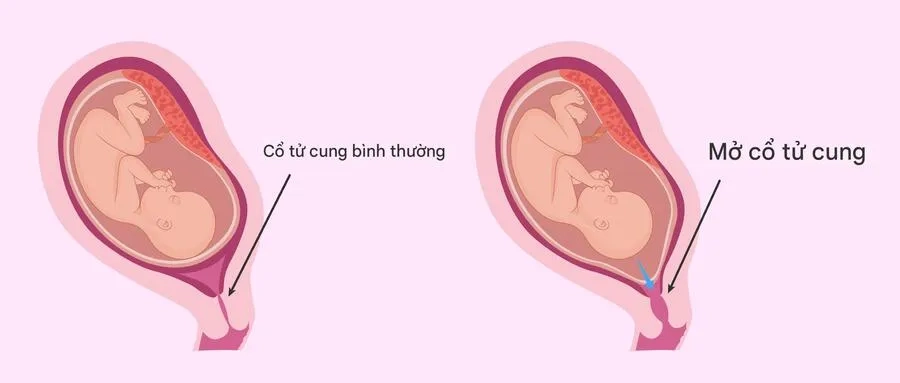Hở eo tử cung là tình trạng cổ tử cung yếu, dễ mở trước thời điểm sinh