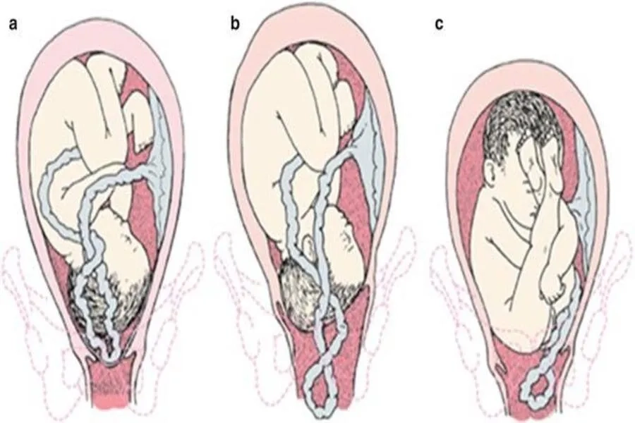Sa dây rốn là tình huống cấp cứu sản khoa nguy hiểm