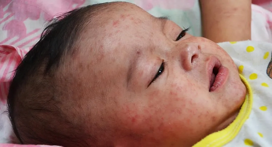 Triệu chứng sốt và nổi ban đỏ khiến bệnh sởi và sốt phát ban dễ bị nhầm lẫn ở trẻ nhỏ