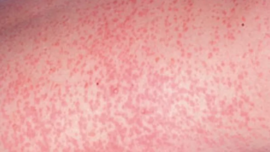 Hình ảnh phát ban đặc trưng của Rubella