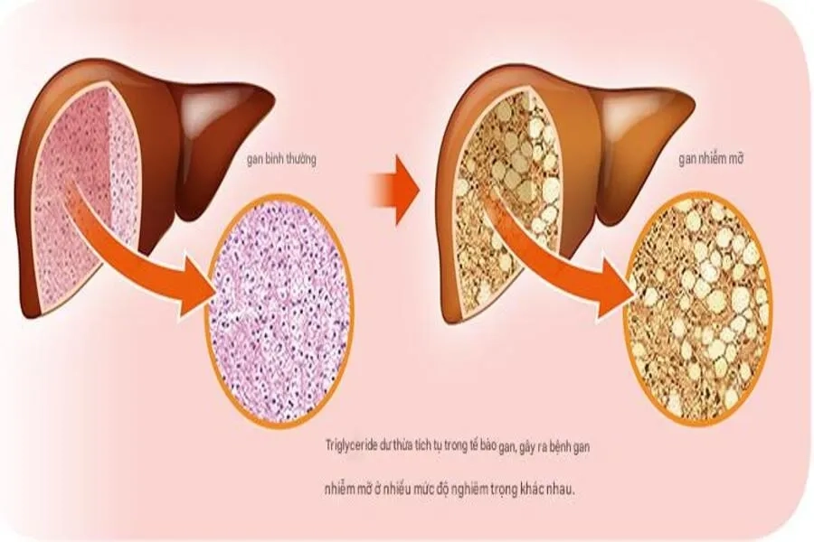 Gan nhiễm mỡ xảy ra khi mỡ tích tụ quá nhiều trong gan