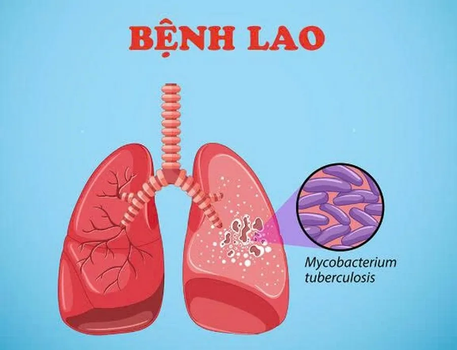 Vắc xin BCG phòng ngừa các bệnh lý liên quan đến vi khuẩn gây bệnh lao