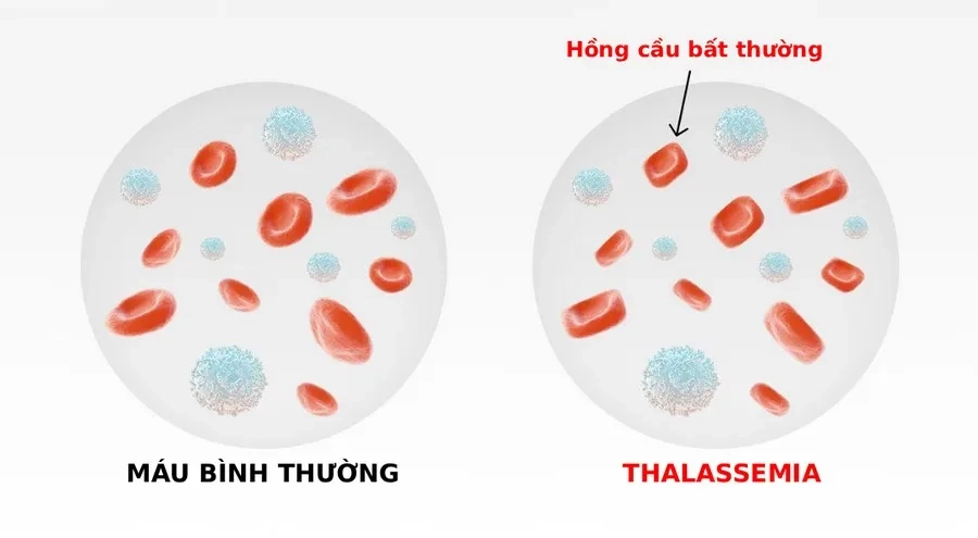 Bệnh tan máu bẩm sinh khiến hemoglobin không được tổng hợp đủ, làm hồng cầu kém bền, dễ bị phá hủy, gây thiếu máu mạn tính