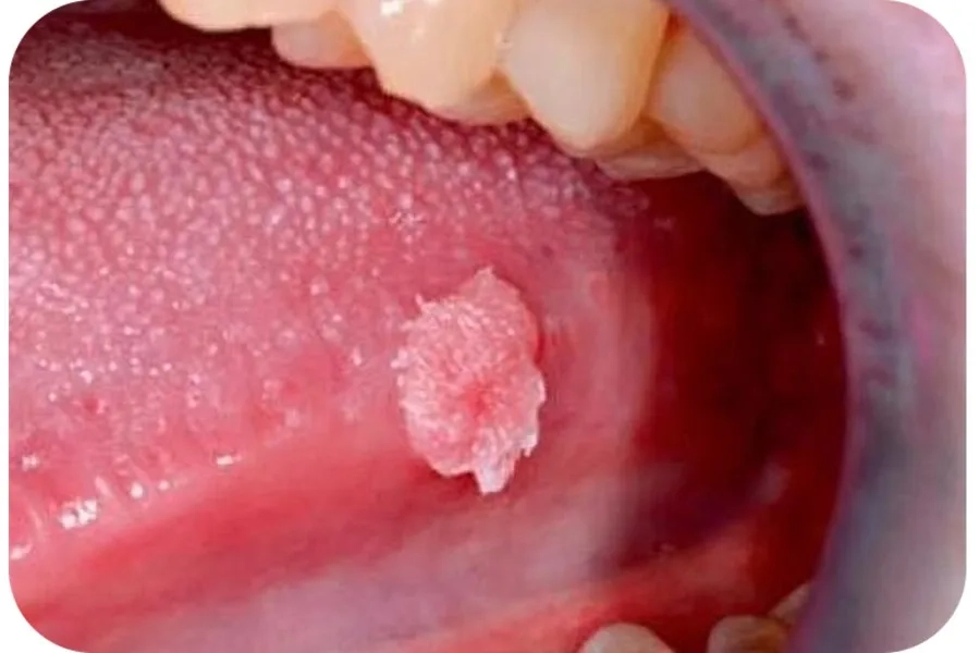 Virus HPV gây nên sùi mào gà ở miệng