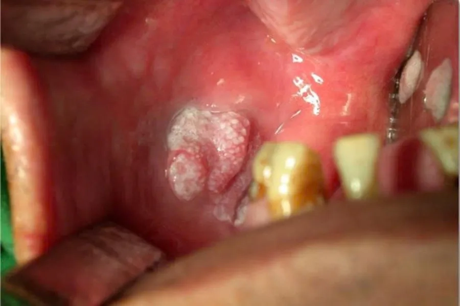 Tuýp HPV 6 và 11 là nguyên nhân hàng đầu gây u nhú ở miệng