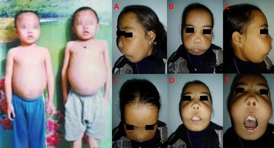 Trẻ mắc bệnh tan máu bẩm sinh có biểu hiện: Mũi tẹt, da xanh xao, xương mặt biến dạng, bụng to do gan lách to 
