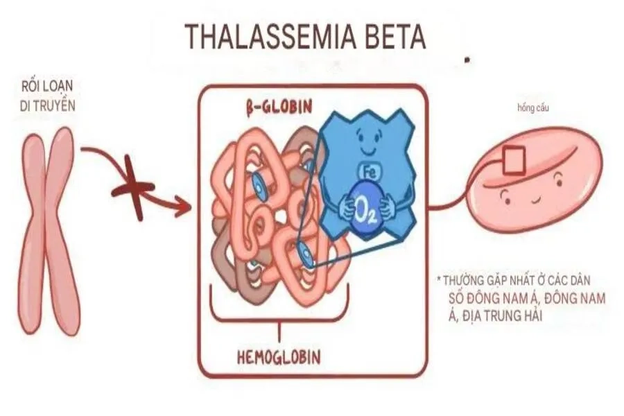 Sơ đồ cơ chế bất thường di truyền của bệnh Beta Thalassemia