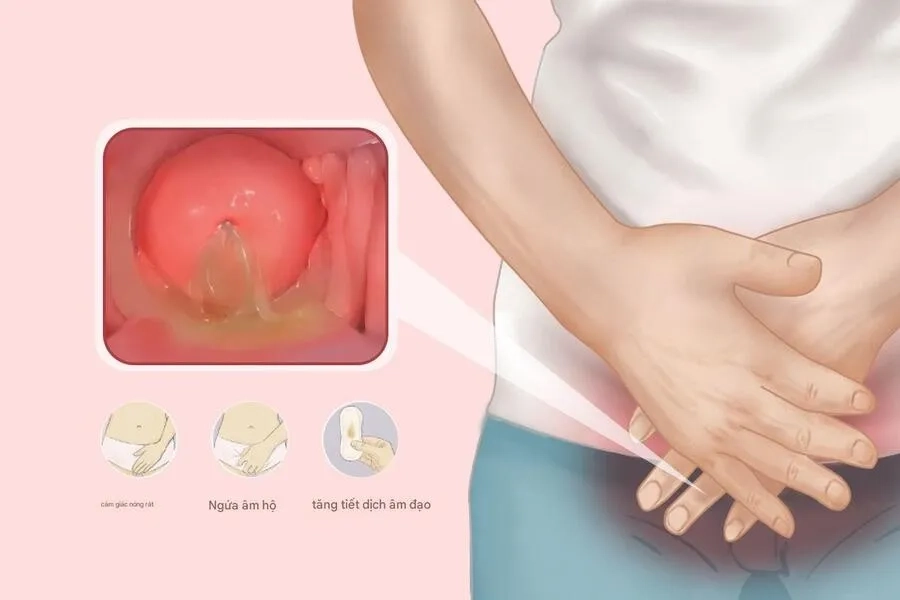 Viêm nhiễm phụ khoa là một trong những nguyên nhân gây vỡ nước ối mà tử cung chưa mở