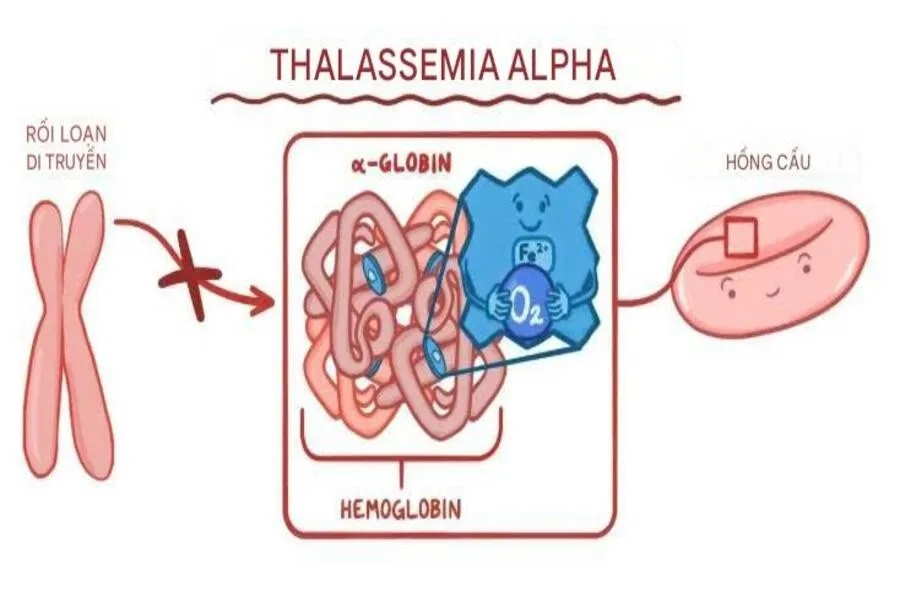 Sơ đồ cơ chế bất thường di truyền của bệnh Alpha Thalassemia