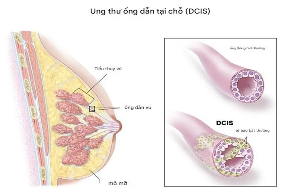 Hình ảnh ung thư ống dẫn tại chỗ 