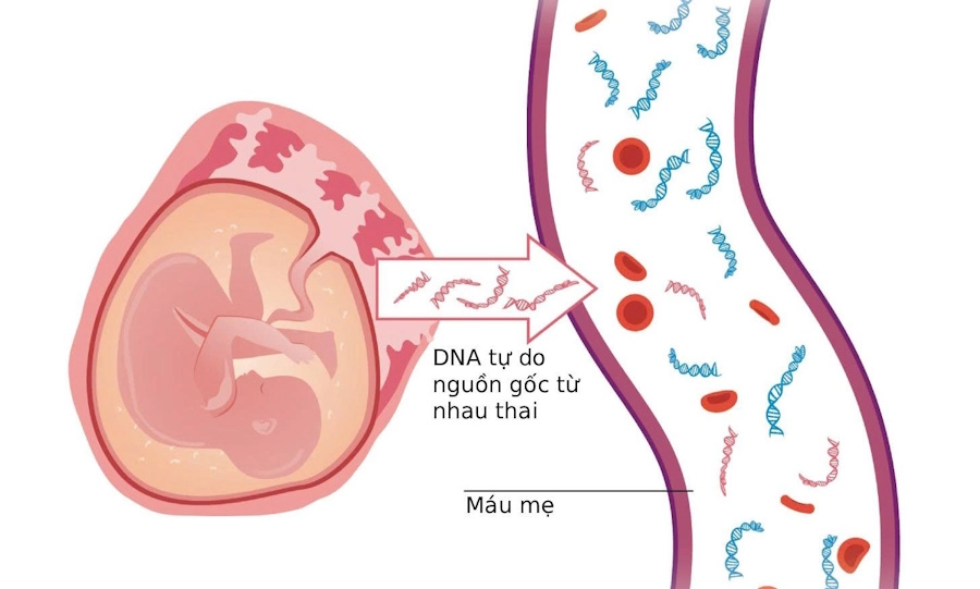 Sàng lọc NIPT (Non-Invasive Prenatal Testing)