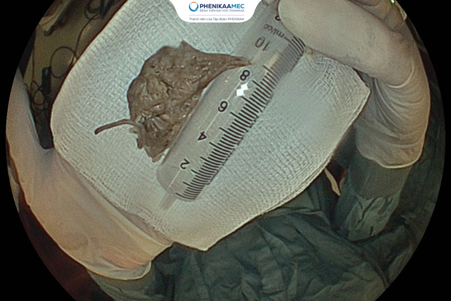 Trung tâm Tiêu hóa PhenikaaMec nội soi gắp thành công dị vật xương dài 9cm mắc sát cơ thắt thực quản trên