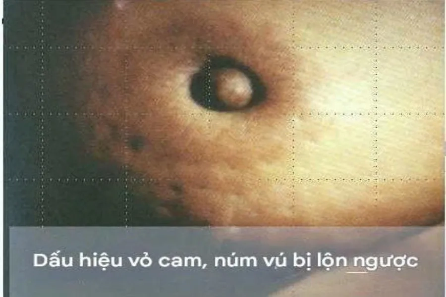 Dấu hiệu của ung thư vú phổ biến là vùng da vú sần sùi như vỏ cam, núm vú bị lộn ngược 