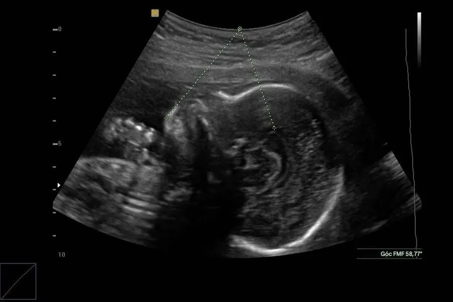 Thai nhi mắc thalassemia có thể bị phù thai, tim to bất thường, rối loạn thể tích dịch ối