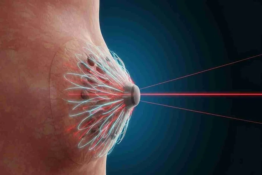 Ung thư vú có thể di căn nhanh chóng nếu không được điều trị kịp thời