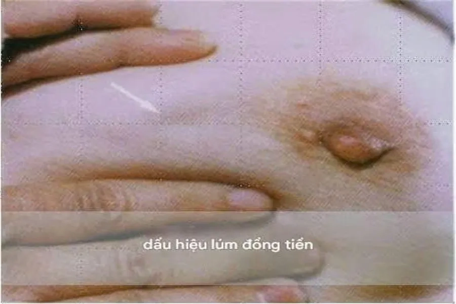 Lúm đồng tiền ở vú có thể là dấu hiệu của bệnh ung thư vú