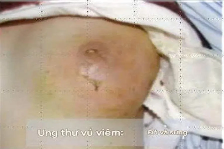 Vú bị sưng, viêm, đỏ, nóng, đau là một trong những dấu hiệu bị ung thư vú