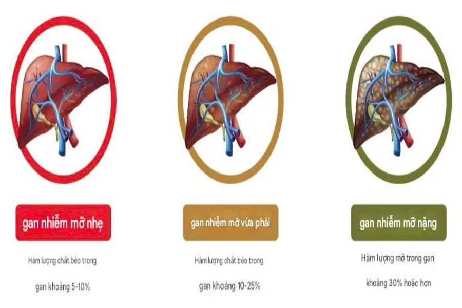 Gan nhiễm mỡ độ 2 là cấp độ “báo động” với hàm lượng mỡ trong gan khoảng 10 - 25%