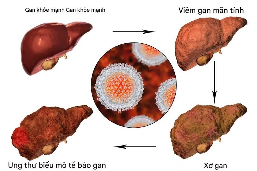 Tiểu đường làm tăng biến chứng gan nhiễm mỡ, viêm gan mãn tính, xơ gan, ung thư biểu mô tế bào gan 