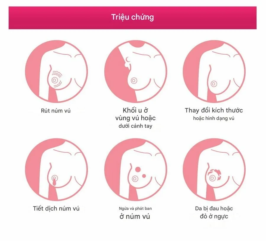Một số dấu hiệu bất thường cảnh báo ung thư vú ở nữ giới
