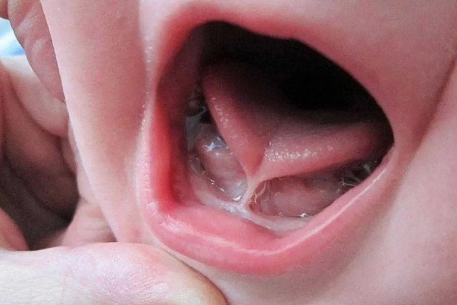 Hình ảnh cho thấy trẻ bị dính thắng lưỡi làm hạn chế cử động lưỡi