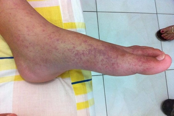 Bệnh Chikungunya có nguy hiểm không?