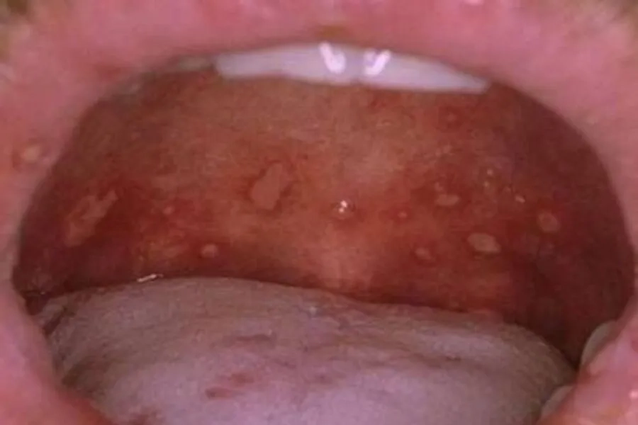 Hình ảnh sùi mào gà do virus HPV ở miệng 