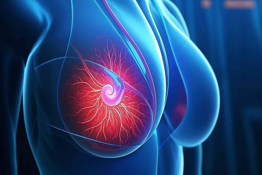 Ở giai đoạn 1, khối u có kích thước nhỏ (dưới 2cm) và chưa lan ra ngoài vú