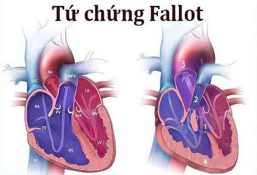 Tứ chứng Fallot là dị tật tim bẩm sinh thường gặp nhất ở trẻ mắc hội chứng DiGeorge: Thông liên thất (1), hẹp van hoặc vùng dưới van động mạch phổi (2), động mạch chủ cưỡi ngựa trên vách liên thất (3), phì đại thất phải (4)