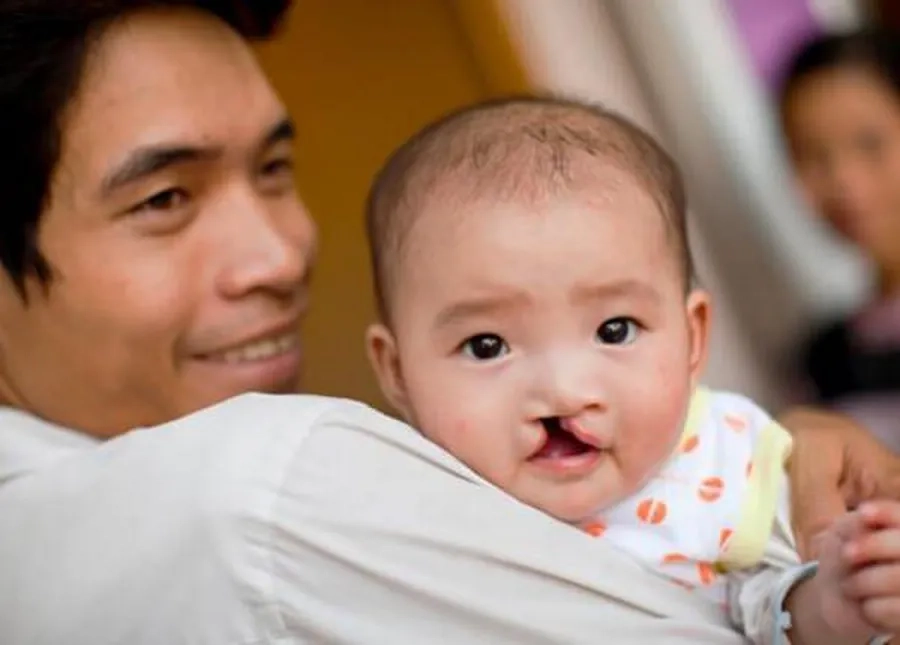 Khe hở môi - vòm miệng là một trong số triệu chứng phổ biến ở trẻ mắc hội chứng này