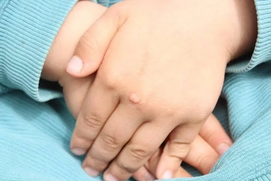 Sùi mào gà ở trẻ em có thể xuất hiện tại da và niêm mạc do nhiễm HPV
