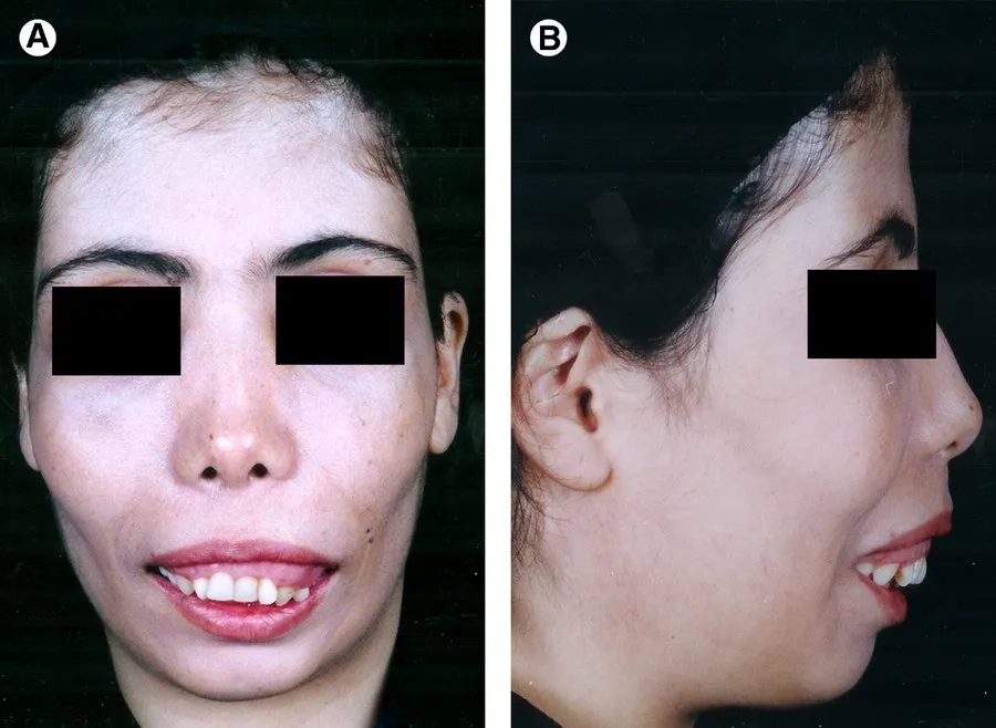Gò má cao và xương hàm to là biểu hiện điển hình của gương mặt Thalassemia