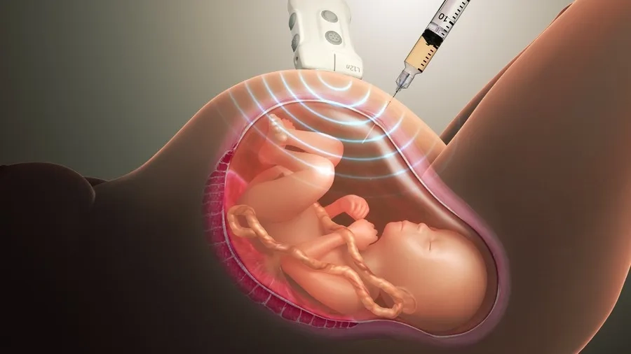 Chọc ối là phương pháp chẩn đoán trước sinh, giúp phát hiện chính xác các bất thường nhiễm sắc thể và bệnh lý đơn gen