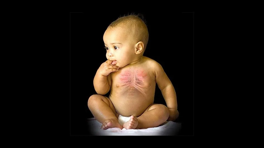 Trẻ mắc xơ nang tụy thường gặp khó khăn trong hấp thu dinh dưỡng và tăng trưởng