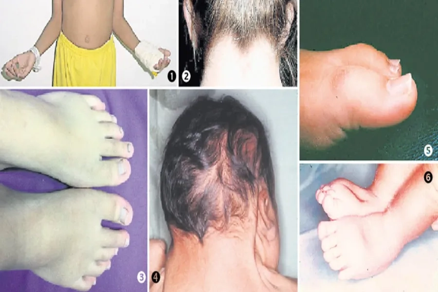Hình ảnh bất thường ở vùng da gáy, tay, chân do hội chứng Turner
