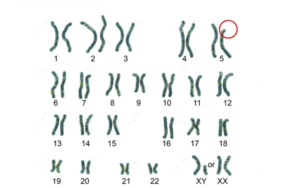 Hình ảnh minh họa mất đoạn nhánh ngắn nhiễm sắc thể số 5 (5p deletion)