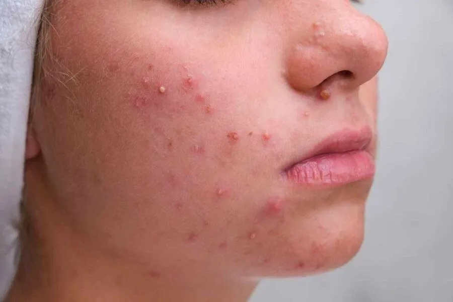 Nổi mụn trứng cá khi mang thai thường do sự gia tăng các hormone trong cơ thể