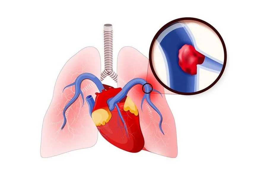 Thuyên tắc phổi có thể gây đau ngực đột ngột, tăng rõ khi hít sâu