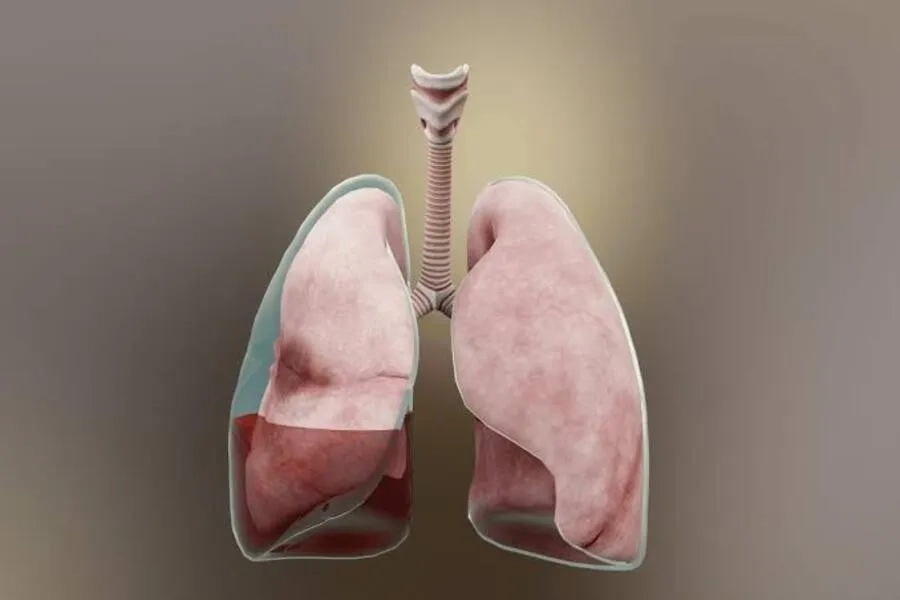 Dịch tích tụ trong khoang màng phổi có thể chèn ép phổi và gây khó thở