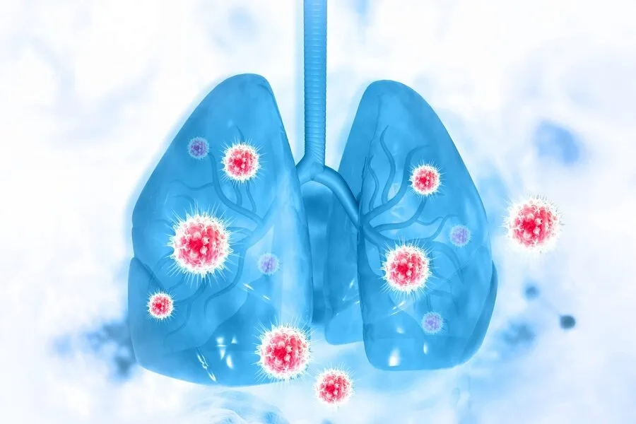Viêm phổi có nhiều căn nguyên, trong khi lao phổi do vi khuẩn lao gây ra