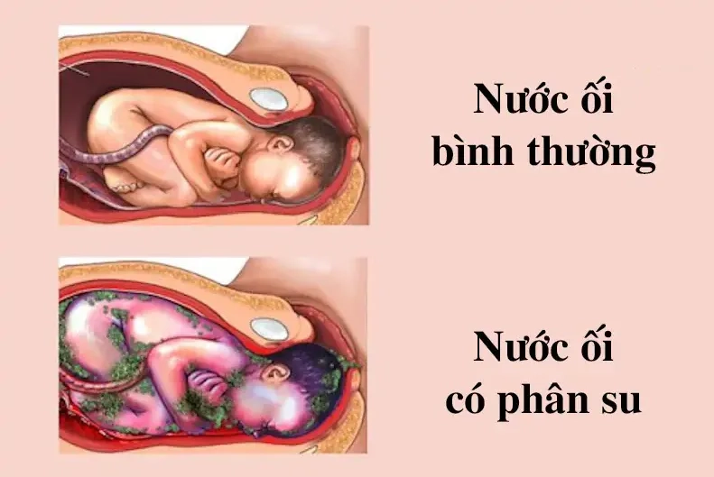 Nước ối đục do phân su sớm hay bị nhiễm trùng ối có thể đe dọa sức khỏe thai nhi