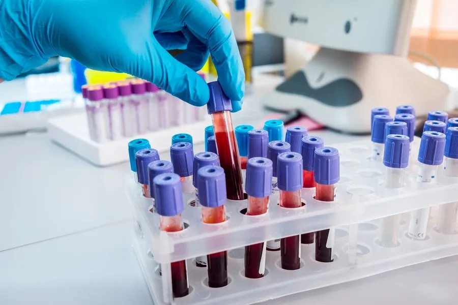 Xét nghiệm máu giúp chẩn đoán chính xác thể bệnh Thalassemia