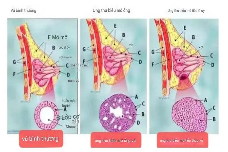 Phân biệt ung thư biểu mô ống vú và ung thư biểu mô tiểu thùy xâm lấn 