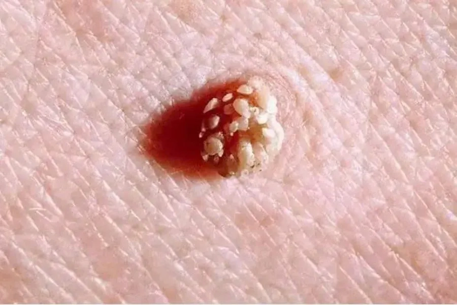 Virus HPV chủng 6 và 11 có thể gây mụn cóc sinh dục (sùi mào gà)