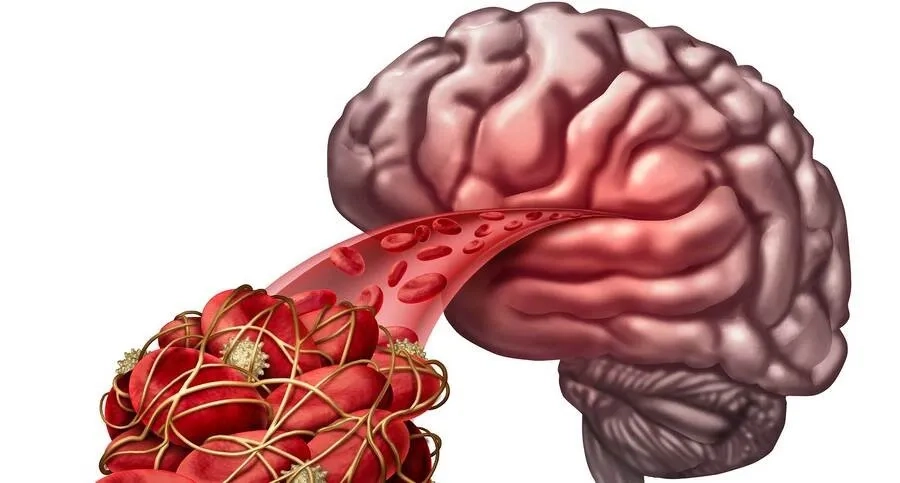 Cục máu đông làm tắc động mạch và cản trở dòng máu đến não