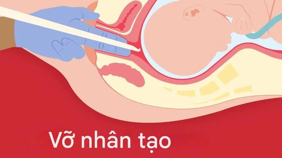 Bấm ối là một thủ thuật sản khoa được bác sĩ thực hiện nhằm làm rách túi ối một cách chủ động