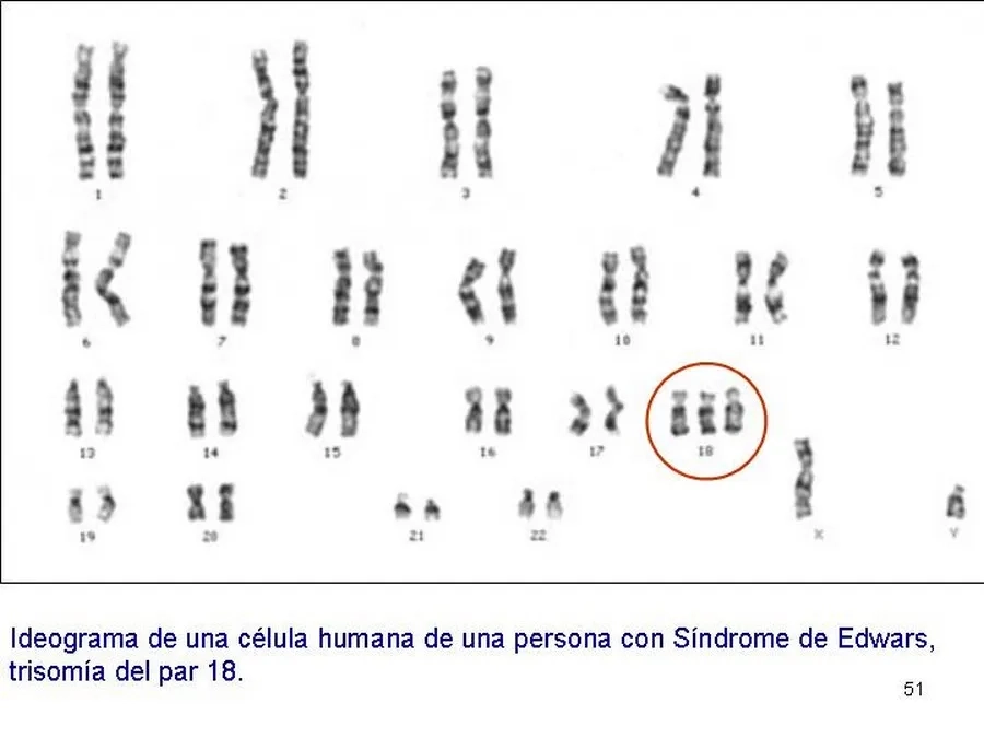 Hình ảnh phân tích công thức NST tế bào có thêm NST 18